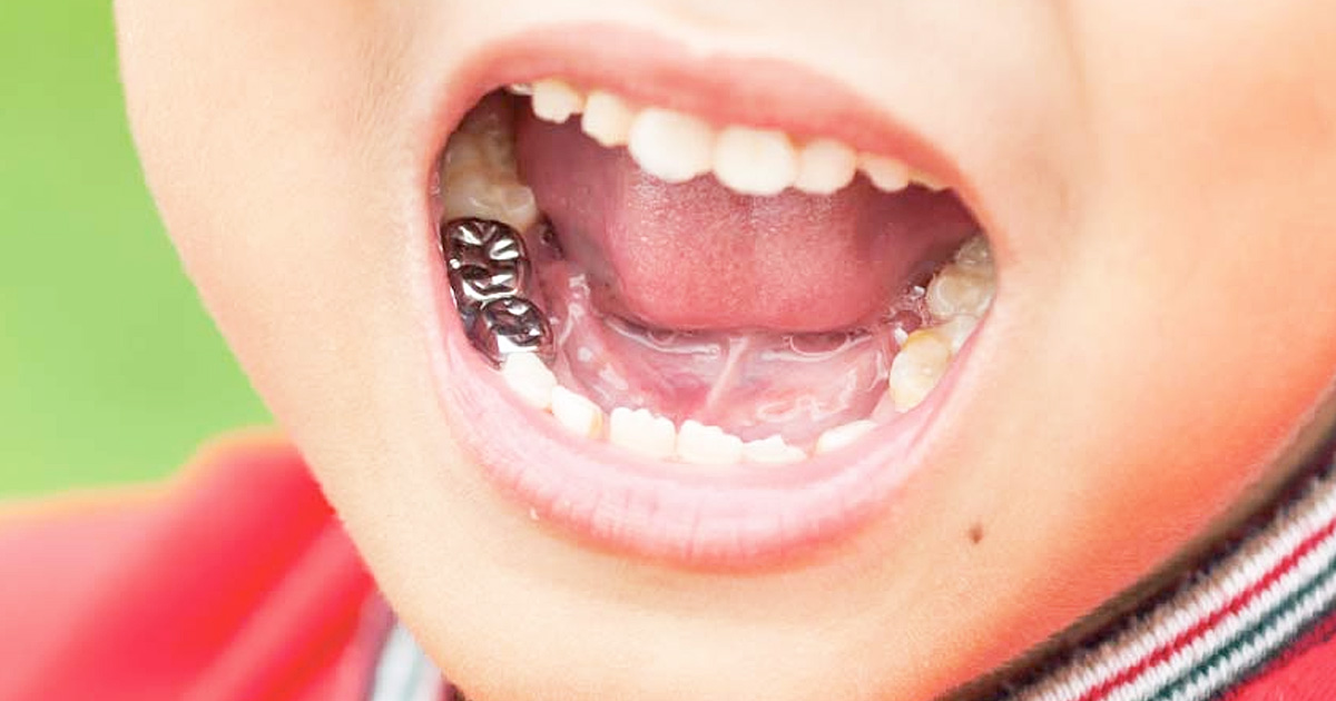 Dental-Crowns-for-baby-teeth